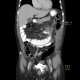 Mesenteric abscess, gastroenteroanastomosis, end-to-side, small-bowel stenosis: CT - Computed tomography